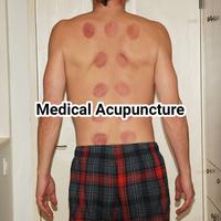 Medical acupuncture